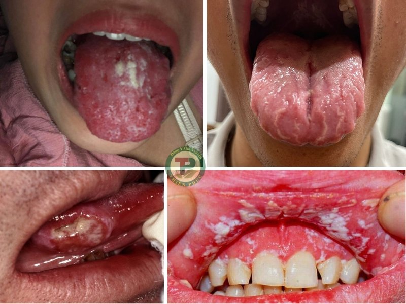 Những biến chứng nguy hiểm khi bị nấm lưỡi